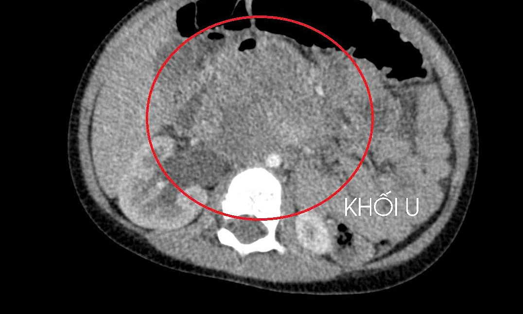 3세 아동, 고환암 진단