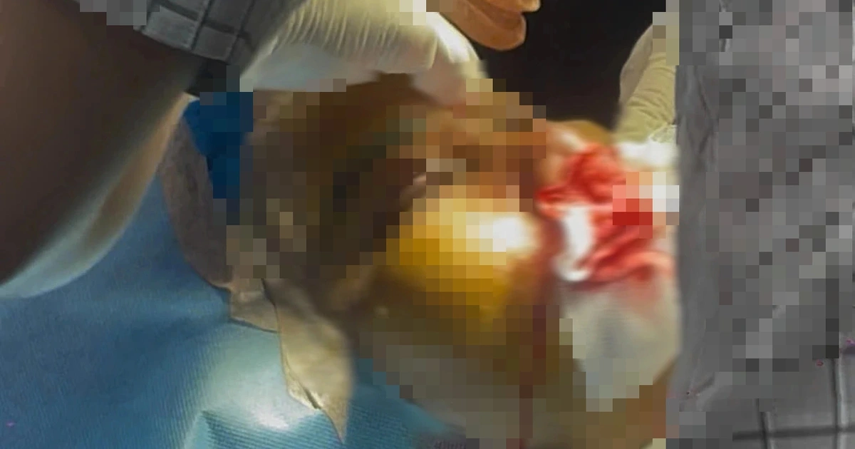 호찌민서 30대 여성 '백옥주사' 홈케어 시술 후 사망…공안 수사