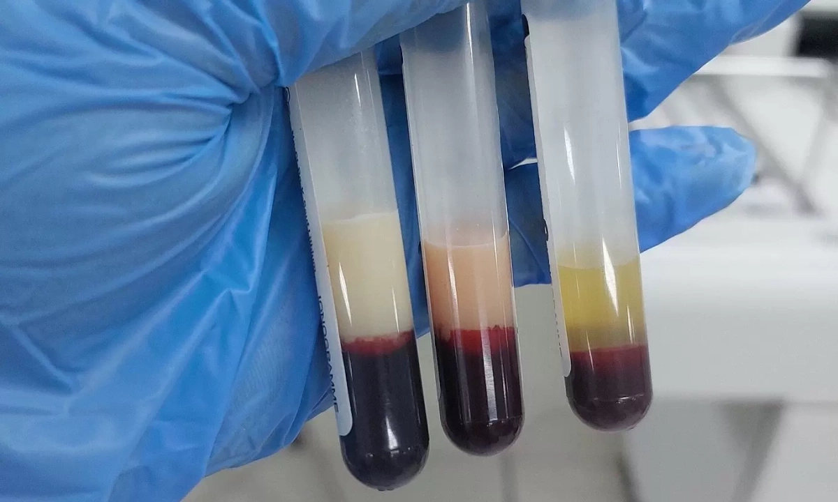 연휴 뒤 찾아온 '우유 빛깔 혈액'의 경고… 30대 남성, 급성 괴사성 췌장염으로 위독