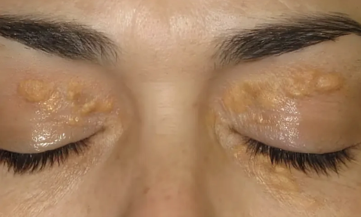 얼굴에 나타나는 두 가지 징후, 나쁜 콜레스테롤 위험 수치 경고