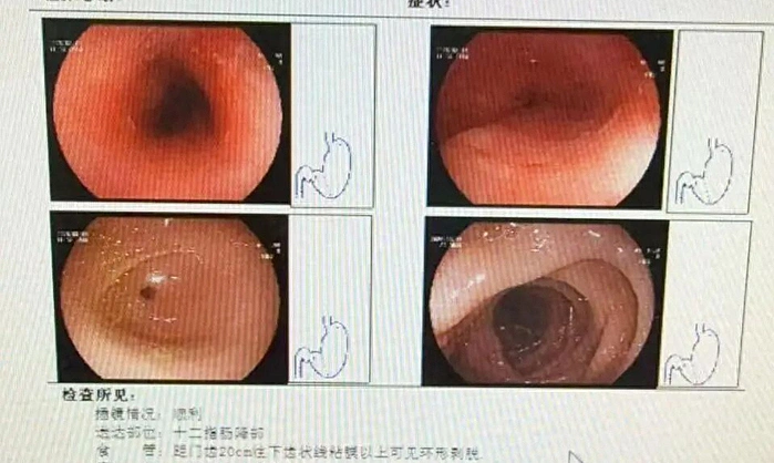 훠궈 고기 씹지 않고 '꿀꺽'… 42세 여성, 식도 8cm 통째로 녹아내려 '충격'