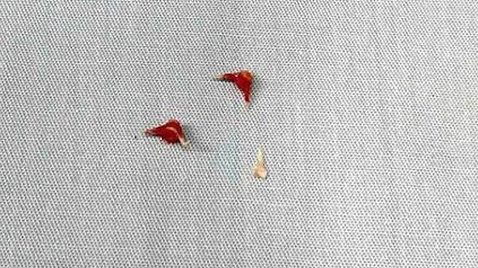 생후 7개월 영아, 뱀장어 뼈 기도 박혀 인공호흡기 신세