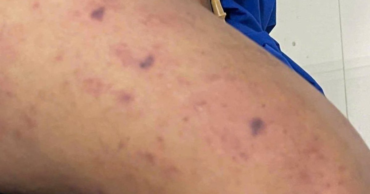 호찌민 뇌수막구균 감염 학생 발생…접촉자 99명 파악